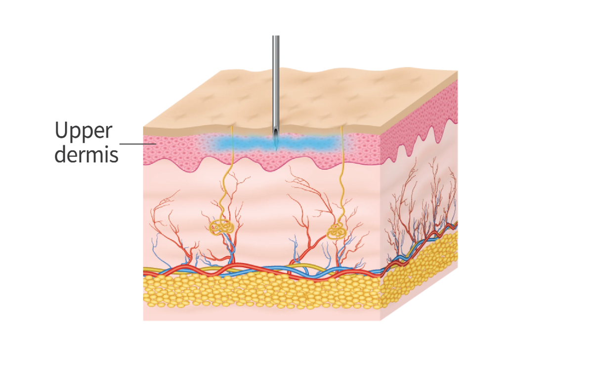 The DermaSource - TURTLEPIN III Stamping Needles(3EA) + Syringes(3EA) Set: 0.5mm